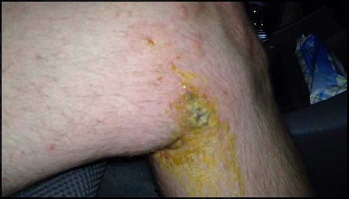 David Ashton's Knee That Was Stabbed With a Poision Oak Branch While Hiking | AdventureHacks